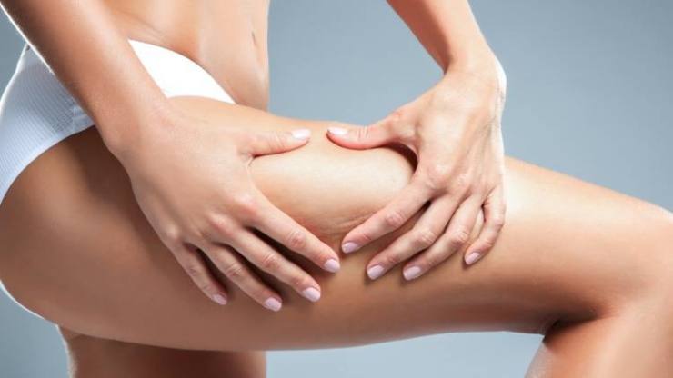 Quanti tipi di cellulite esistono