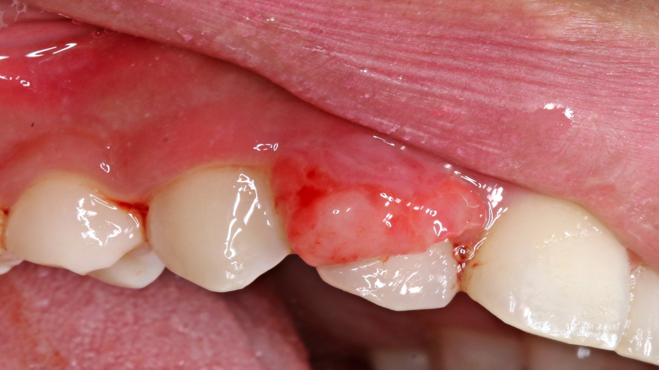 Granuloma dentale: da cosa è causato e quali sono i sintomi