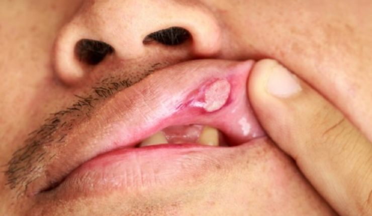 Afte della bocca: cosa sono e come eliminarle