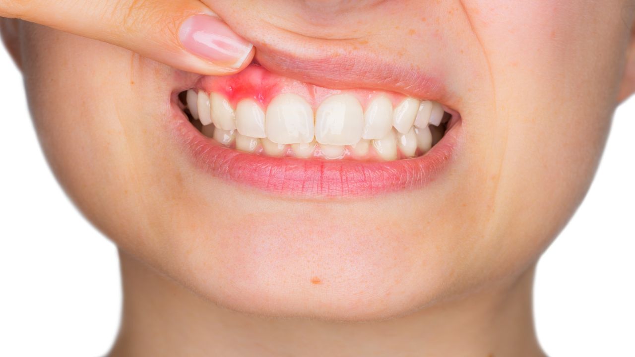 Ascesso dentale: cause e rimedi per il dolore