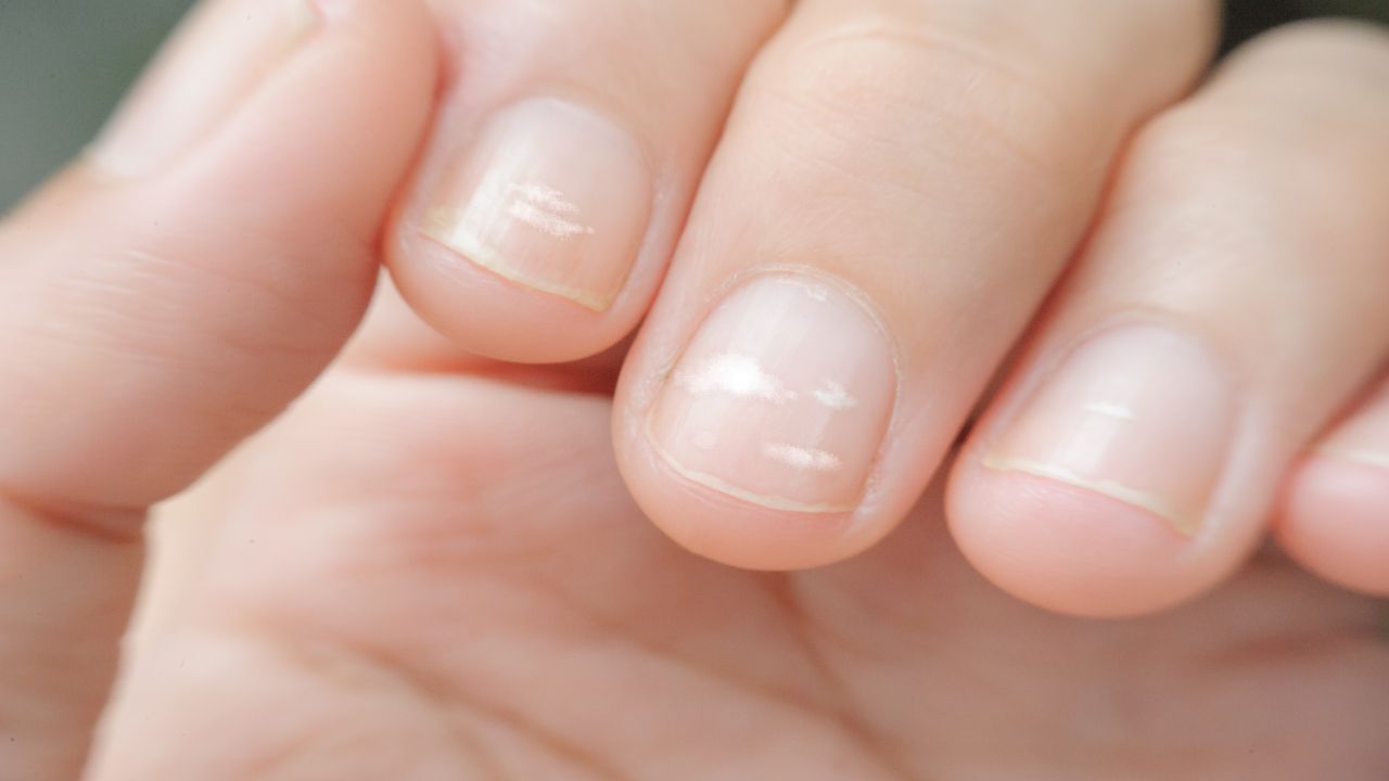 Macchie bianche sulle unghie: i rimedi naturali per combattere la leuconichia