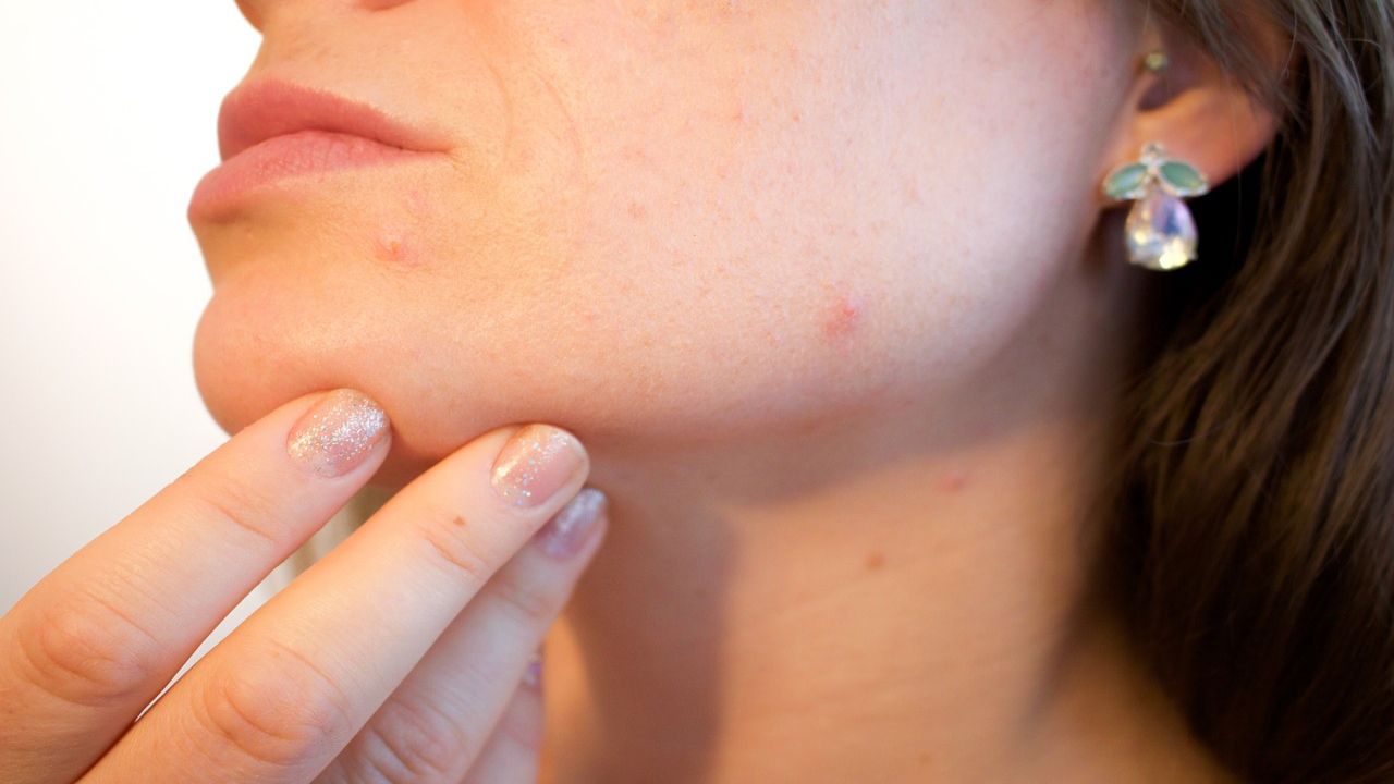 Acne e alimentazione: i cibi da evitare e quelli che aiutano a combatterla