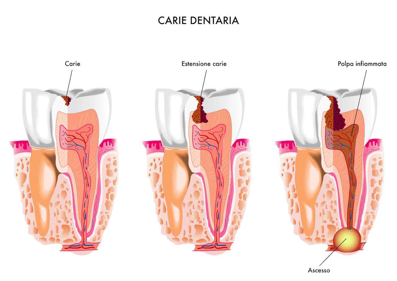 Carie dentaria