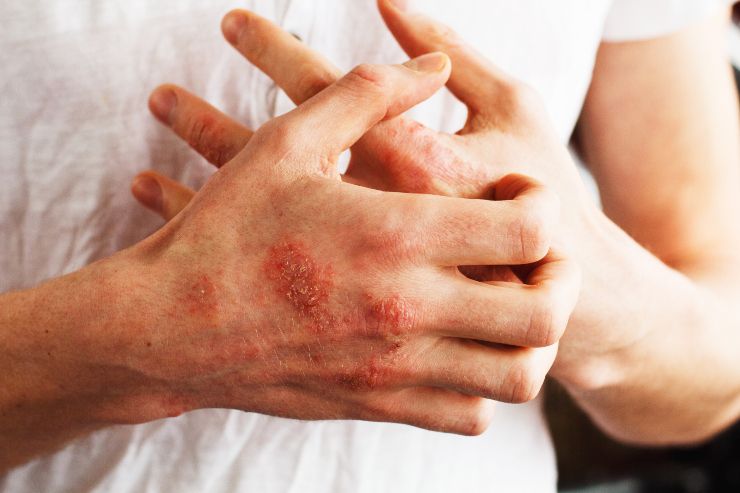 Il Sole fa bene contro la psoriasi? La risposta degli esperti