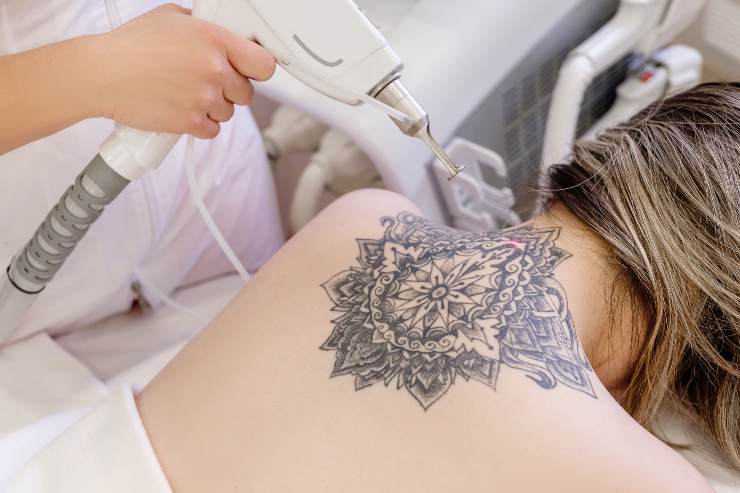 Togliere un tatuaggio