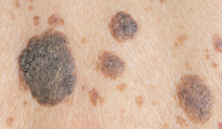 Distinguere neo e melanoma