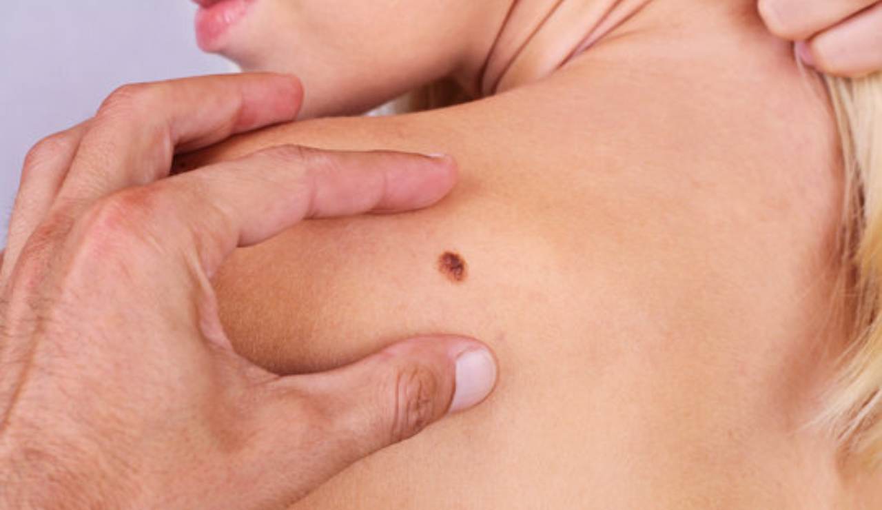 Distinguere neo e melanoma