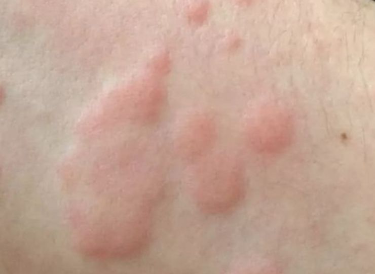 Orticaria: sintomi, cause e trattamenti più efficaci