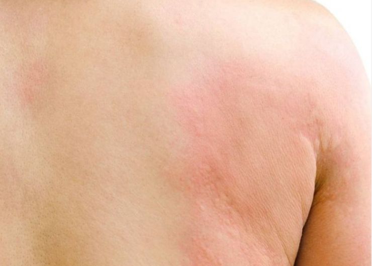 Orticaria: sintomi, cause e trattamenti più efficaci