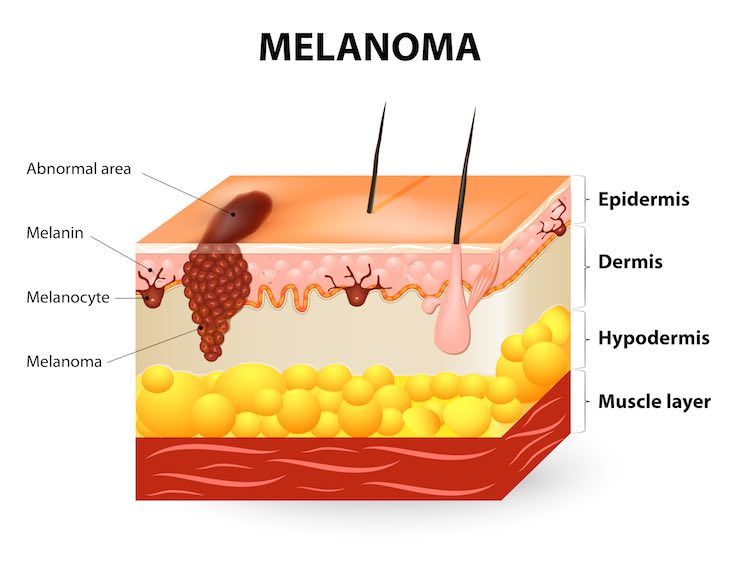 melanoma dettaglio