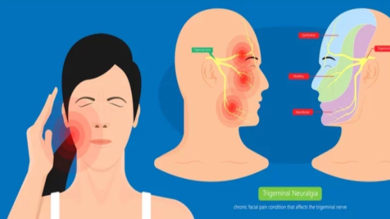 Nevralgia del trigemino: le cause scatenanti e rimedi naturali più efficaci