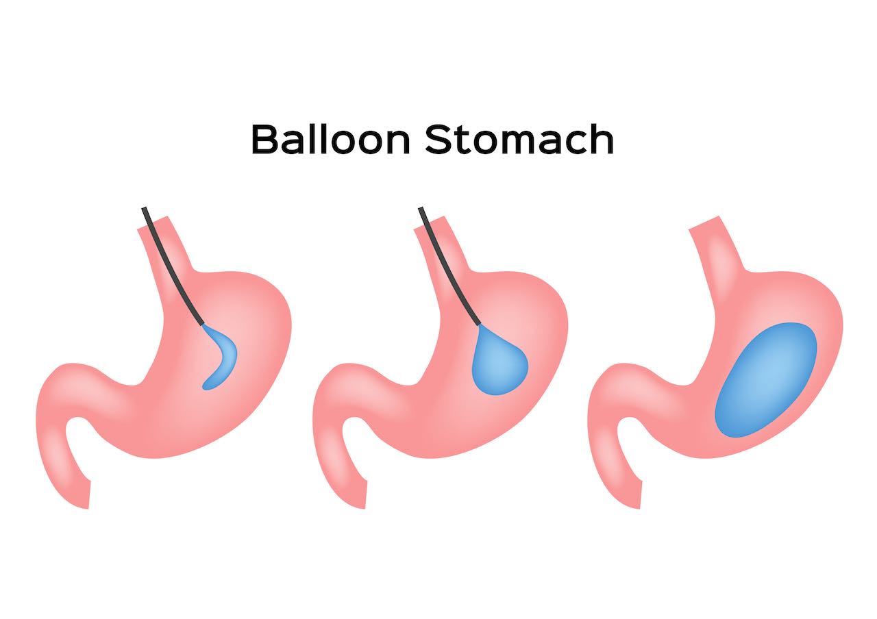 palloncino gastrico