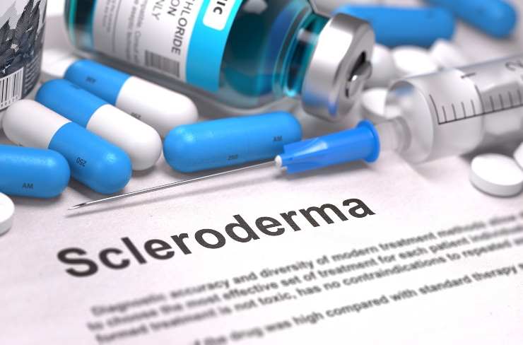 Sclerodermia molto diffusa, cosa è e come si tratta