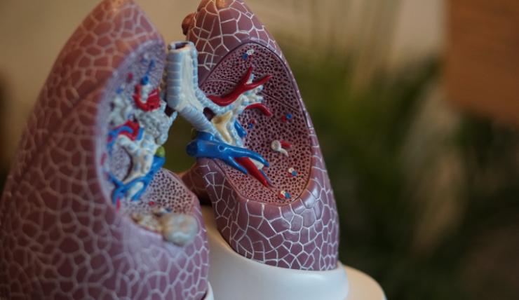 Tumore ai polmoni
