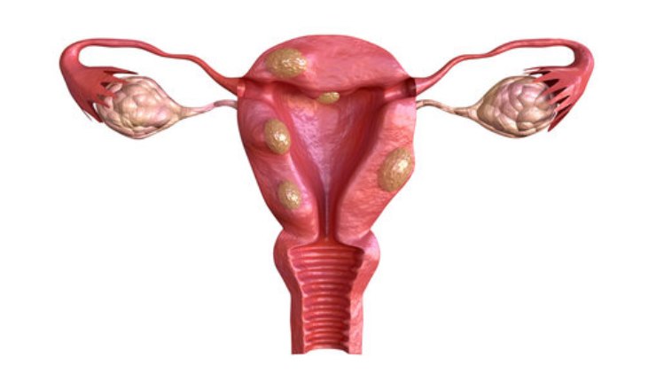 Mioma uterino