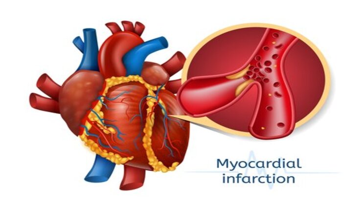 Miocardio