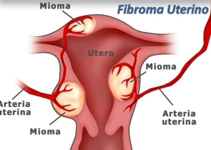 Fibroma uterino: cosa è bene sapere per intervenire presto e bene