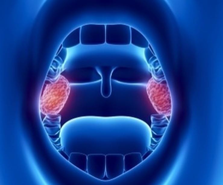 Tonsille sempre ingrossate? Ecco perché e cosa dovete fare