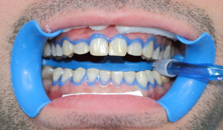 Denti bianchissimi