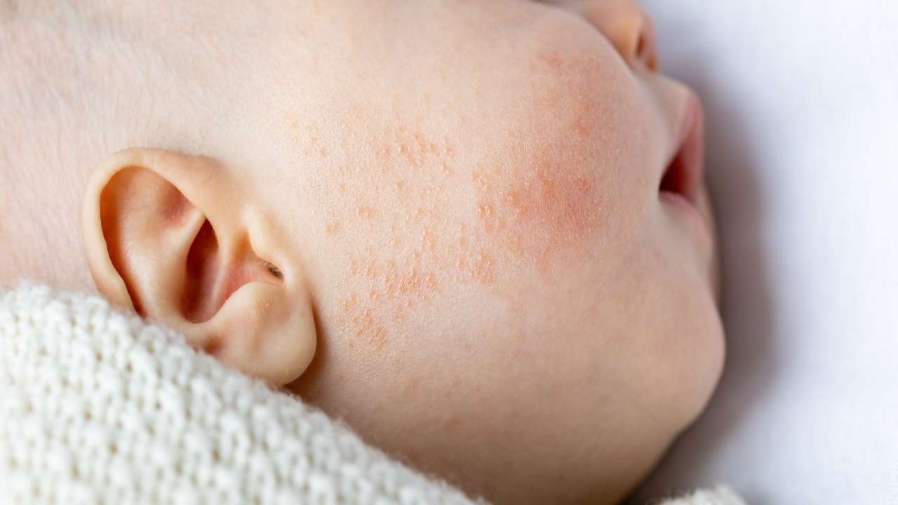 Dermatite atopica nei bambini: le conseguenze psicologiche
