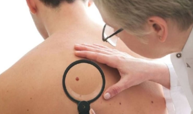 Melanoma in aumento significativo, negli ultimi anni ecco cosa sta succedendo