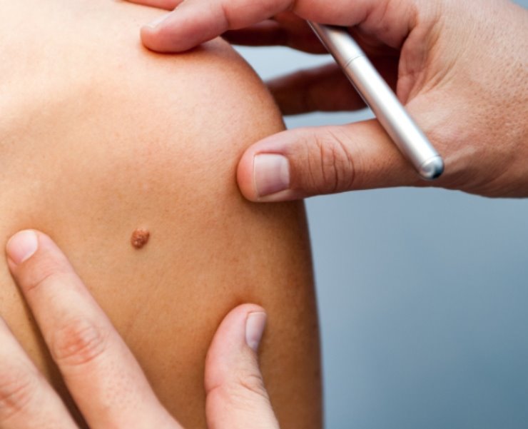 Melanoma in aumento significativo, negli ultimi anni ecco cosa sta succedendo