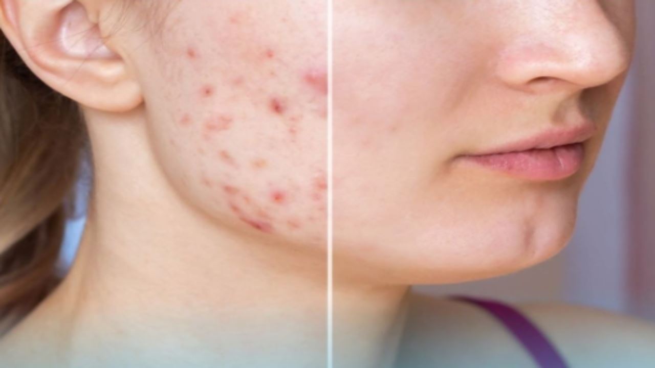 Acne come trattarla per non peggiorare la situazione