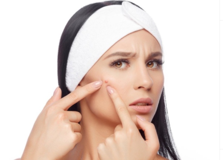 Acne come trattarla per non peggiorare la situazione