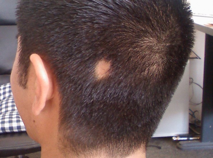 Alopecia, la malattia di cui si parla: cos'è e come si cura