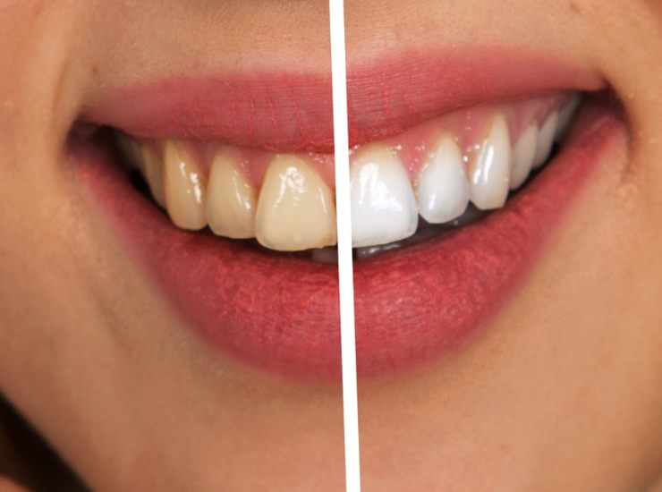 Macchie sui denti: come eliminarle a casa con metodi naturali e sicuri