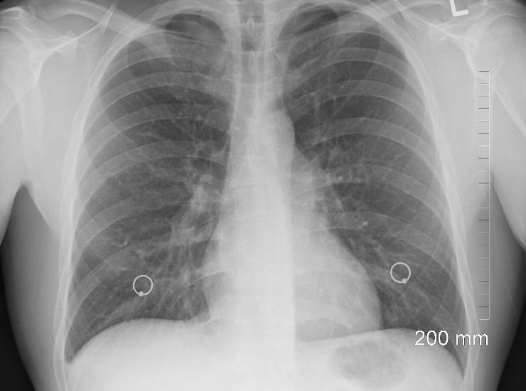 Hai un rischio alto di cancro ai polmoni? L'invenzione che lo calcola