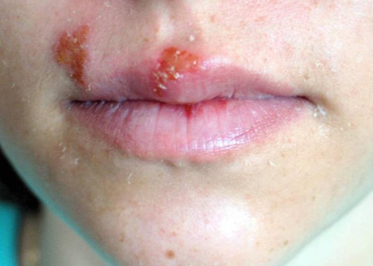 Herpes legami diabete - NonSapeviChe