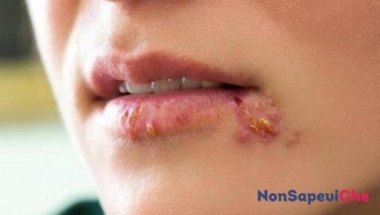 Herpes legami diabete - NonSapeviChe