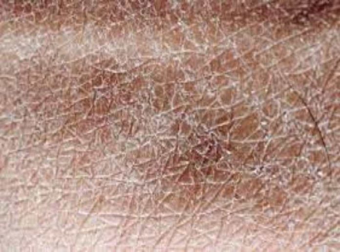 Pelle delle gambe secca, non sottovalutare mai questo sintomo, potrebbe essere un campanello di Pelle delle gambe secca, non sottovalutare mai questo sintomo, potrebbe essere un campanello di