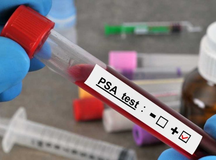 Cancro alla prostata: la verità sul test del psa