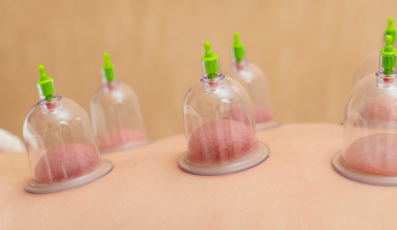 Cupping o coppettazione, la tecnica usata dagli sportivi