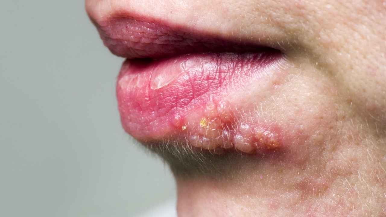 Herpes labiale è vero che si annida dormiente nel tuo corpo, come contrastarlo 27072022 Nonsapeviche