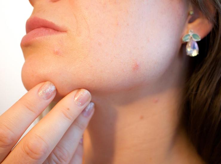 l'acne non è un disturbo solo dell'adolescenza, ecco quanti tipi di acne ci sono e come trattarla 26072022 Nonsapeviche