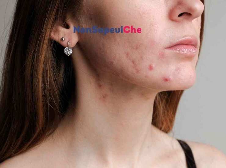 l'acne non è un disturbo solo dell'adolescenza, ecco quanti tipi di acne ci sono e come trattarla 26072022 Nonsapeviche