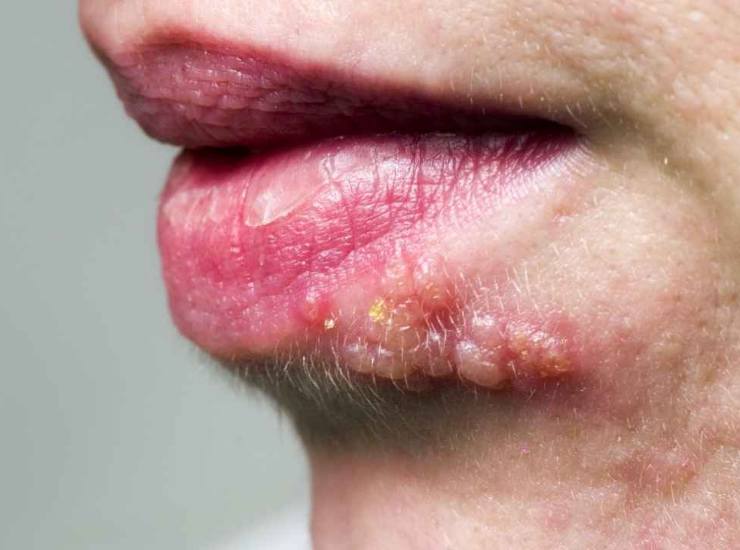 Herpes labiale è vero che si annida dormiente nel tuo corpo, come contrastarlo 27072022 Nonsapeviche