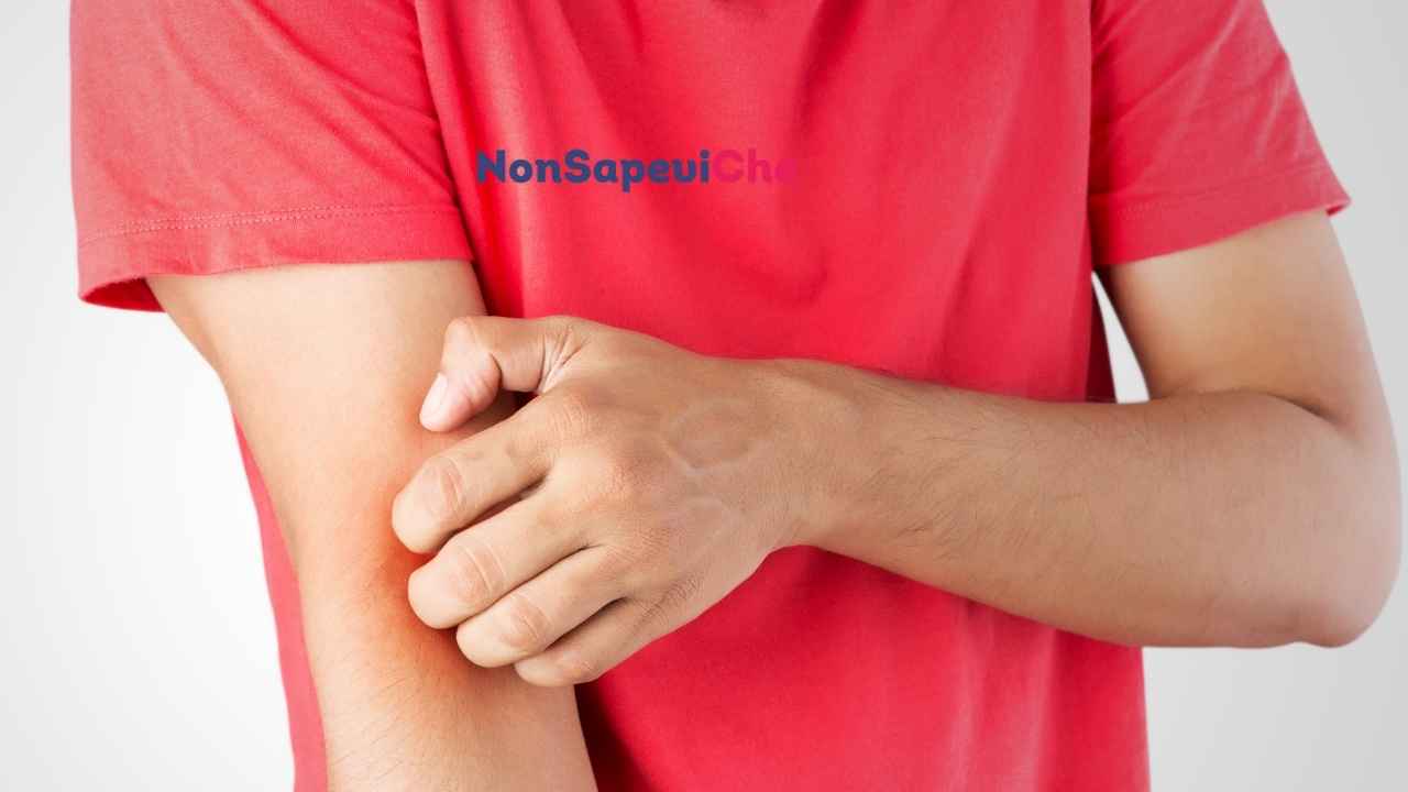 puntura di zanzare, potresti essere allergico come scoprirlo 08092022 Nonsapeviche