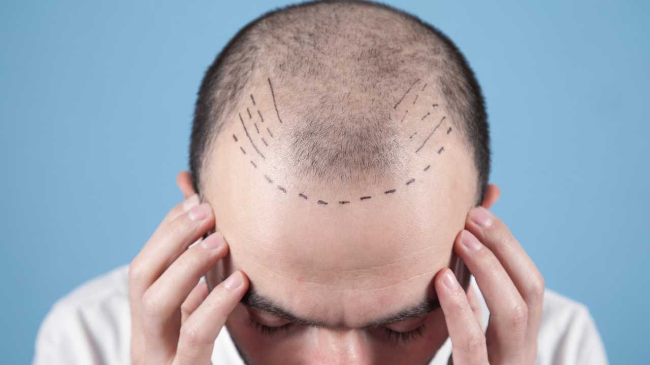 Trapianto capelli Italia o Turchia - NonSapeviChe